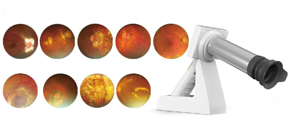 Портативный немидриатический аппарат для офтальмологии Глазное дно Изображение 2